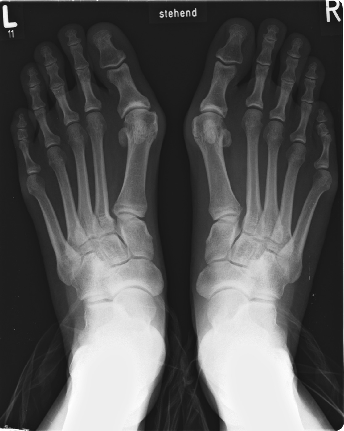 Bilateral hallux valgus. Standing AP radiograph of both forefeet: medial eminence, lateral hallux deviation, increased intermetatarsal angle and lateral sesamoid subluxation. Michael Nebel, Wikimedia Commons, CC BY-SA 2.0 DE.