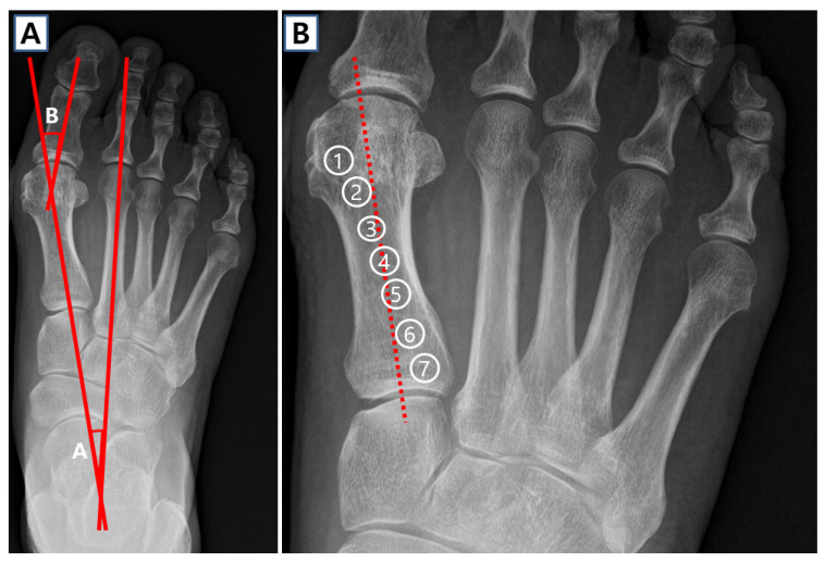 Radiographic parameters of hallux valgus. (A) Hallux valgus angle (HVA) and intermetatarsal angle (IMA) constructed on an AP radiograph; (B) the seven-grade tibial-sesamoid position classification. Cho et al., J Clin Med 2025;14:5072, Fig. 1 (CC BY 4.0).