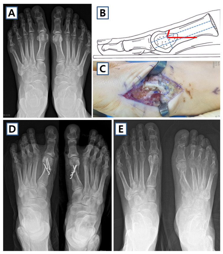 Distal chevron osteotomy for hallux valgus. Pre-operative deformity (A), the osteotomy (B-C) and the corrected, screw-fixed post-operative alignment (D-E). Cho et al., J Clin Med 2025;14:5072, Fig. 4 (CC BY 4.0).