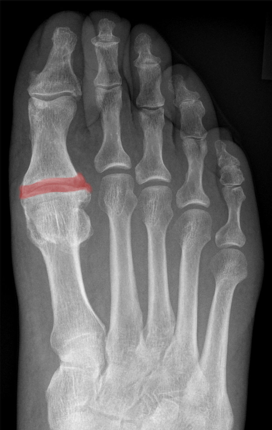Hallux rigidus. AP radiograph with the first-MTP joint space highlighted, showing narrowing in a 66-year-old man without hallux valgus. Hellerhoff, Wikimedia Commons, CC BY-SA 4.0.