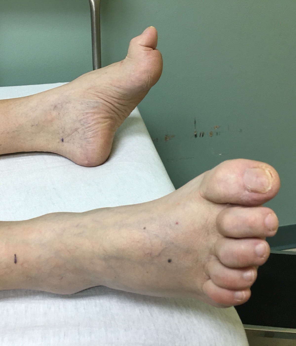 Hammer/claw toes. Clinical photograph showing flexion deformity of the lesser toes with dorsal prominence at the proximal interphalangeal joints. Wwcmdmsha (neurosigns.org), Wikimedia Commons, CC BY-SA 4.0.