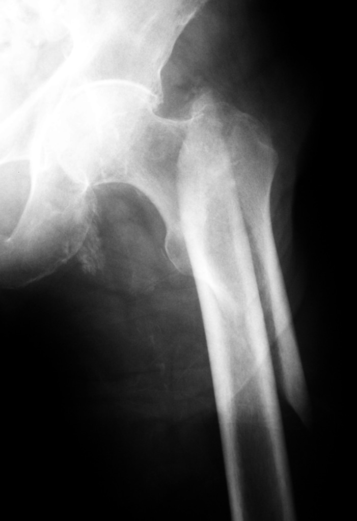 Figure 4. Subtrochanteric femoral fracture on a close-up AP radiograph of the proximal femur, with the fracture line running from just below the trochanters into the proximal shaft. Image by THWZ, CC BY-SA 3.0, via Wikimedia Commons.