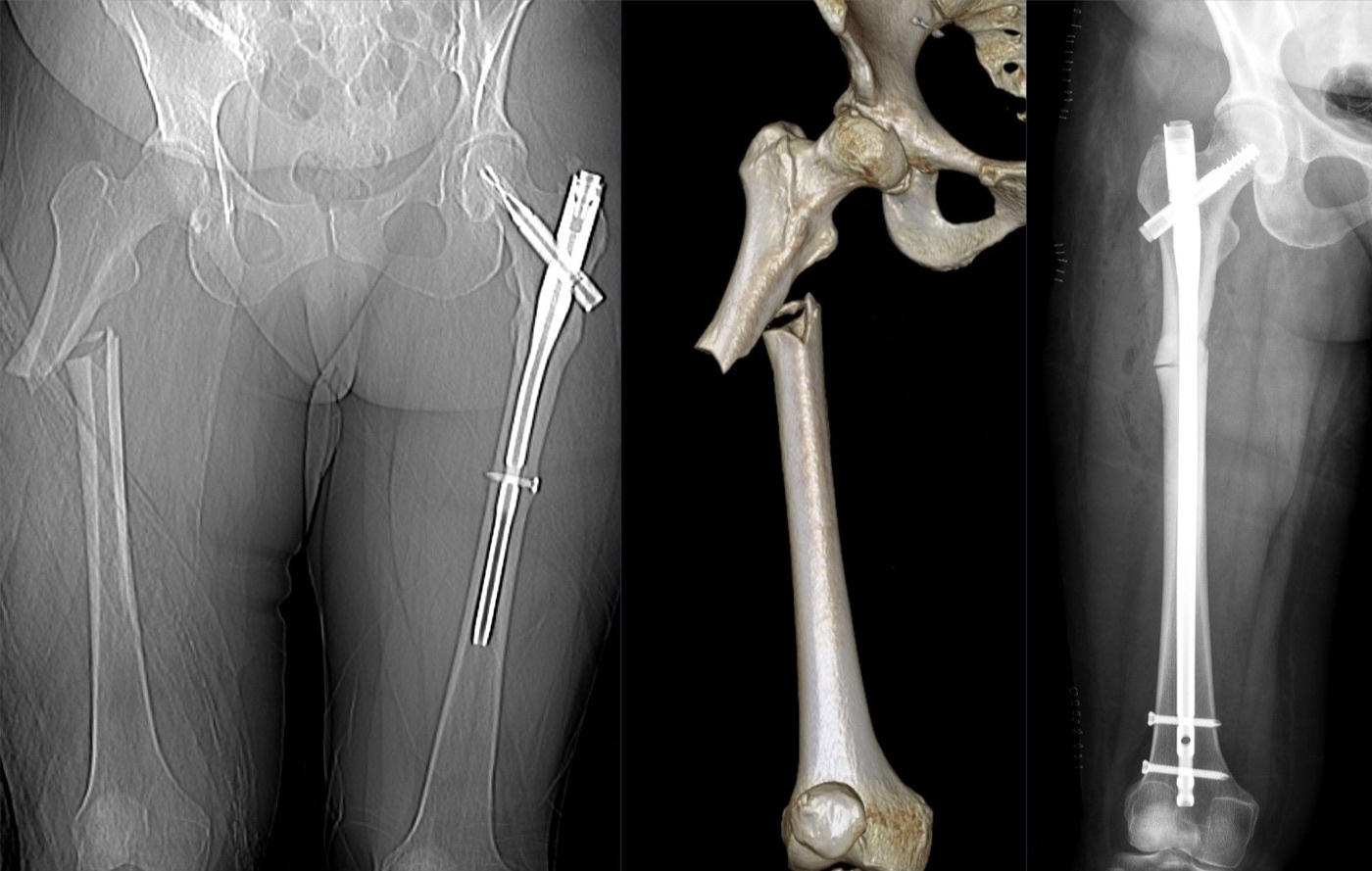 Figure 7. Atypical (bisphosphonate-associated) femoral fracture: a transverse proximal-shaft fracture with lateral cortical thickening (CT topogram and 3D rendering, left and centre) treated with an intramedullary nail (post-operative radiograph, right); note the indwelling nail in the previously fractured contralateral femur, illustrating the bilateral tendency of these fractures. Image by Hellerhoff, CC BY-SA 4.0, via Wikimedia Commons.
