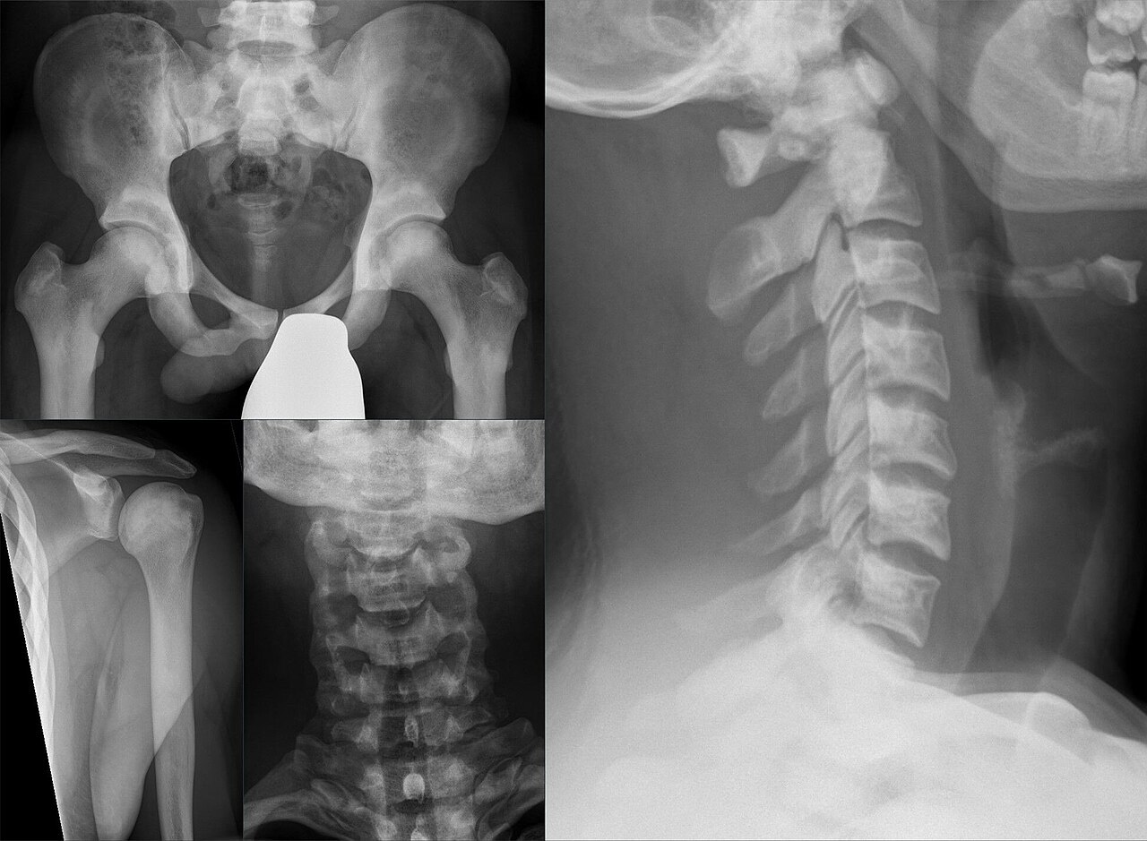 Osteopetrosis. Diffusely dense (“marble”) bones of the pelvis, shoulder and cervical spine, with the “bone-in-bone” vertebral appearance. Hellerhoff, Wikimedia Commons (CC BY-SA 4.0).