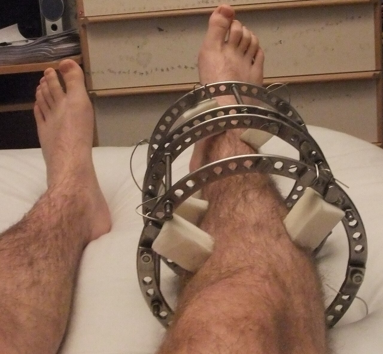 Limb lengthening. An Ilizarov ring external fixator on the leg - the apparatus used for gradual lengthening and deformity correction in short stature. Pagemaker787, Wikimedia Commons (CC BY-SA 4.0).