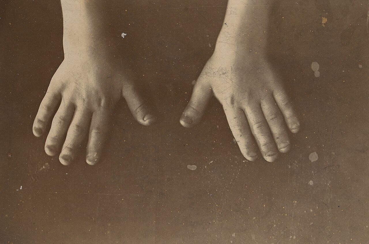 Trident hand in achondroplasia. The short, stubby digits with a persistent gap between the middle and ring fingers. Wellcome Collection (CC BY 4.0).