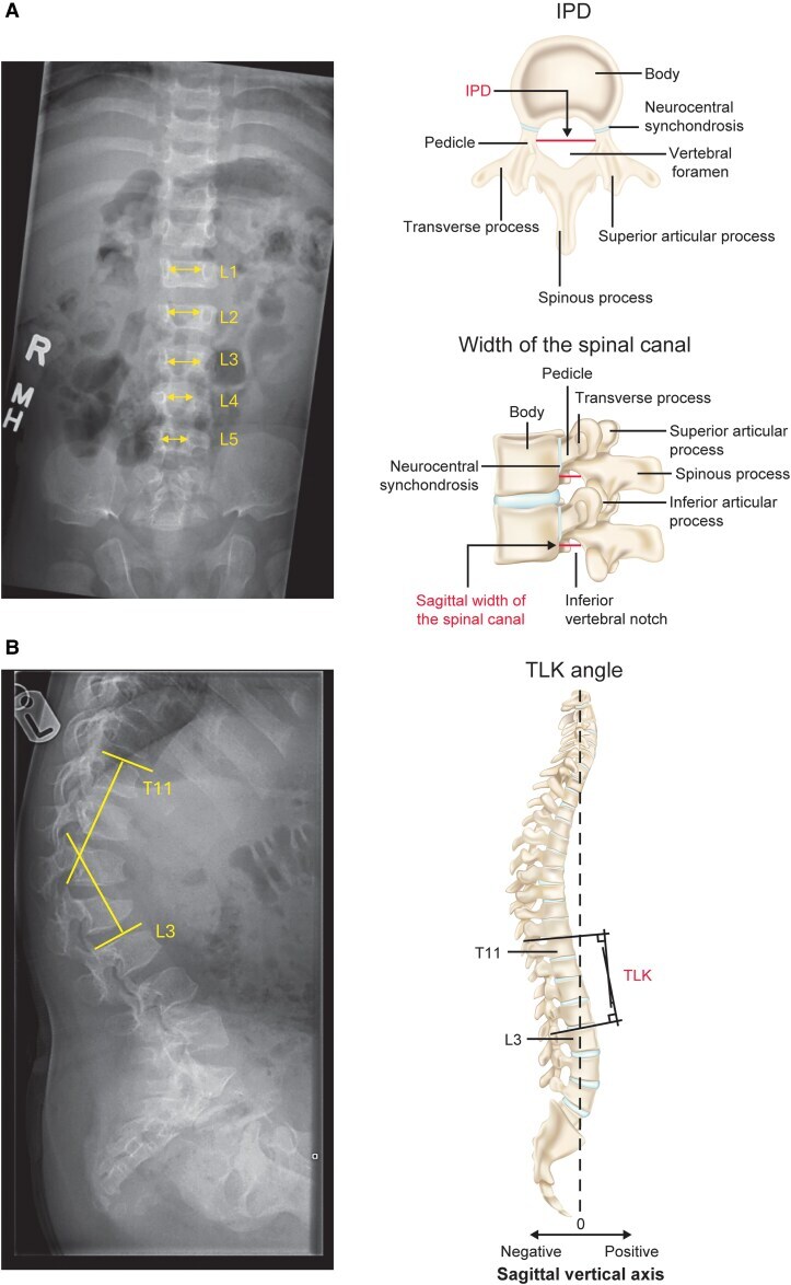 Radiographic signs of achondroplasia. (A) AP lumbar spine - the interpedicular distance fails to widen caudally (measured L1-L5); (B) lateral spine - thoracolumbar kyphosis (T11-L3). The right-hand panels are explanatory anatomy. Hoover-Fong J et al., J Endocr Soc 2026;10(3):bvag008, Fig. 1 (CC BY 4.0).