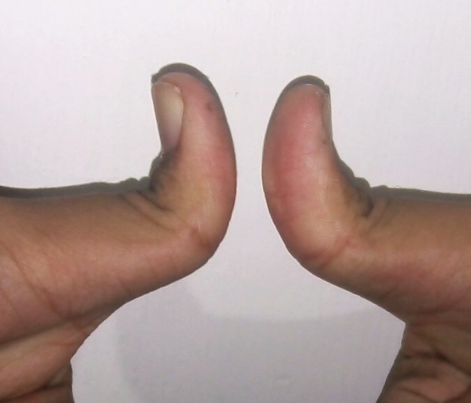 The “hitchhiker thumb” sign. Marked proximal placement and abduction of the thumbs - the characteristic hand sign of diastrophic dysplasia (illustrated here as the posture/sign). Rollcloud, Wikimedia Commons (CC0).