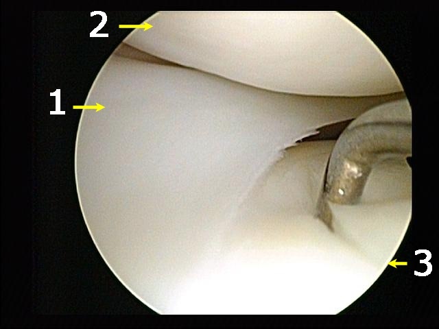 Figure 18. Annotated arthroscopic view inside the knee: the meniscus (1), the femoral condyle articular cartilage (2) and the arthroscopic probe (3) against damaged tibial cartilage. Arthroscopist / S. Fruitsmaak, CC BY-SA 3.0, via Wikimedia Commons.