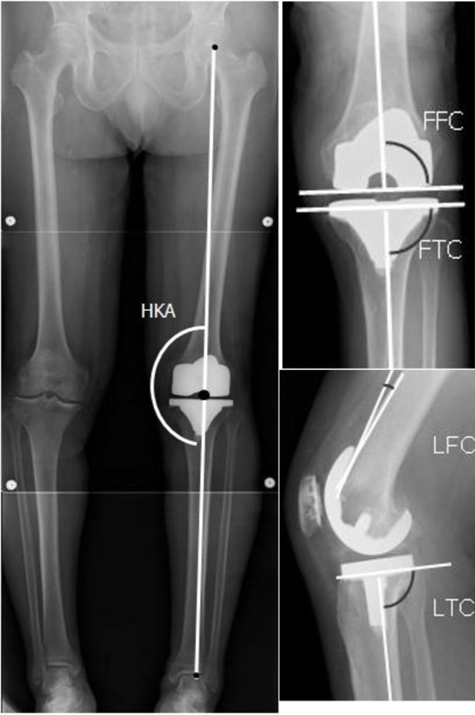 Figure 19. Radiograph of a total knee replacement with limb-alignment measurement: standing full-length view with zoomed anteroposterior and lateral views of the femoral and tibial components. Inui et al. (2013), CC BY 2.0, via Wikimedia Commons.
