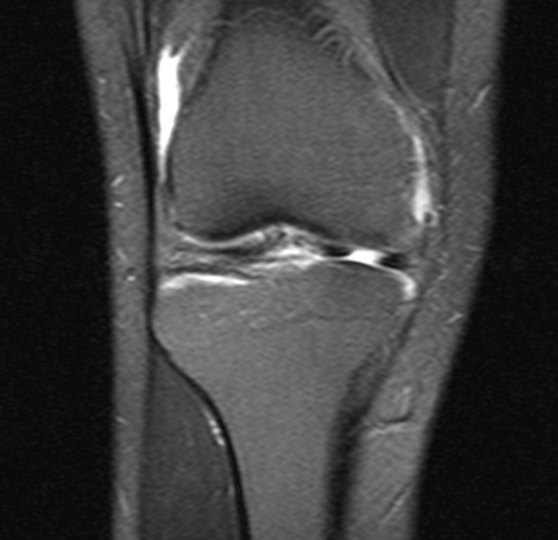 Figure 26. Magnetic resonance image of the knee demonstrating a meniscal tear. Ciernik M, CC BY-SA 4.0, via Wikimedia Commons.