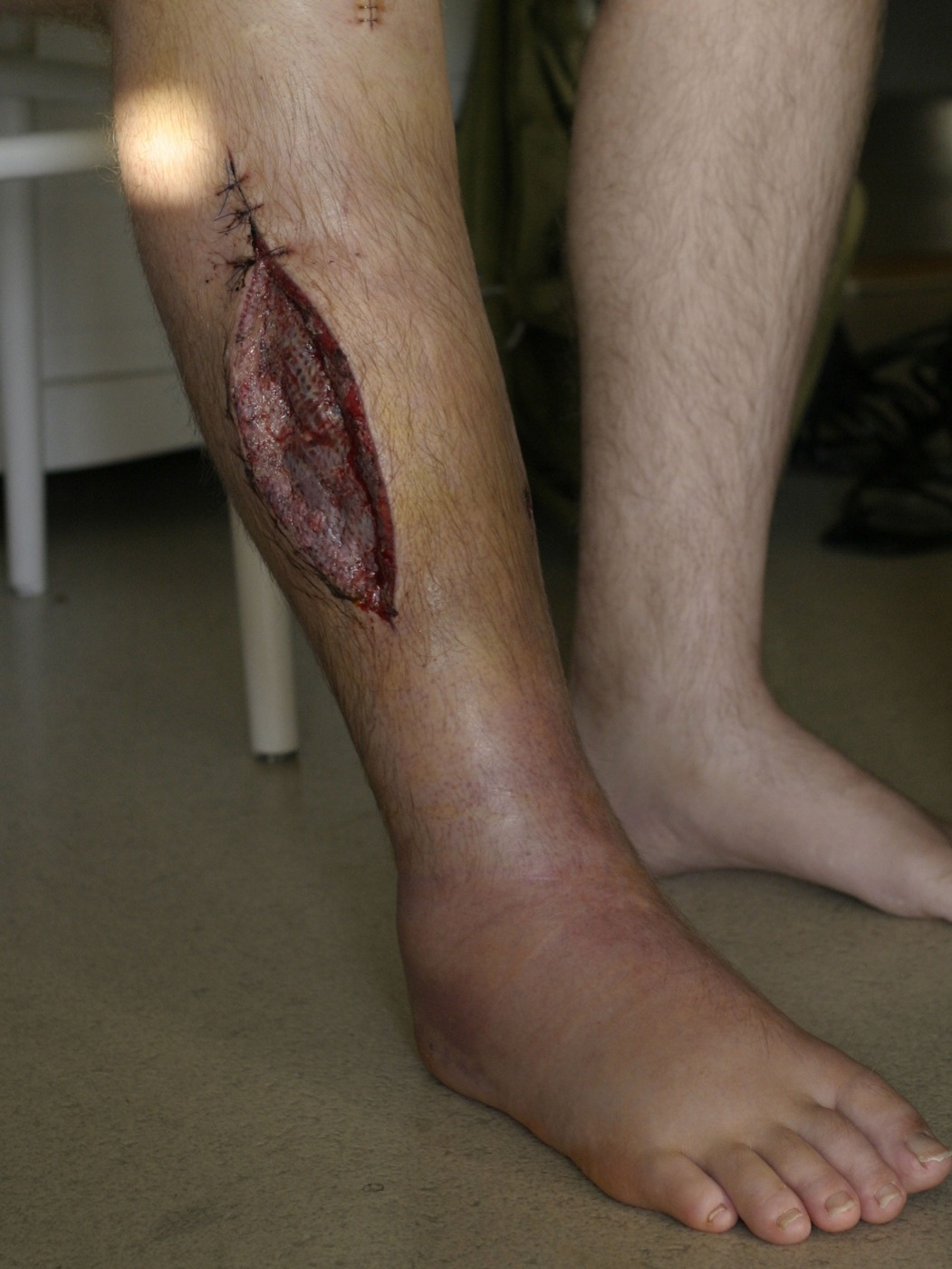 Figure 3. Medial leg fasciotomy wound after decompression for compartment syndrome. CC BY-SA 3.0, via Wikimedia Commons.
