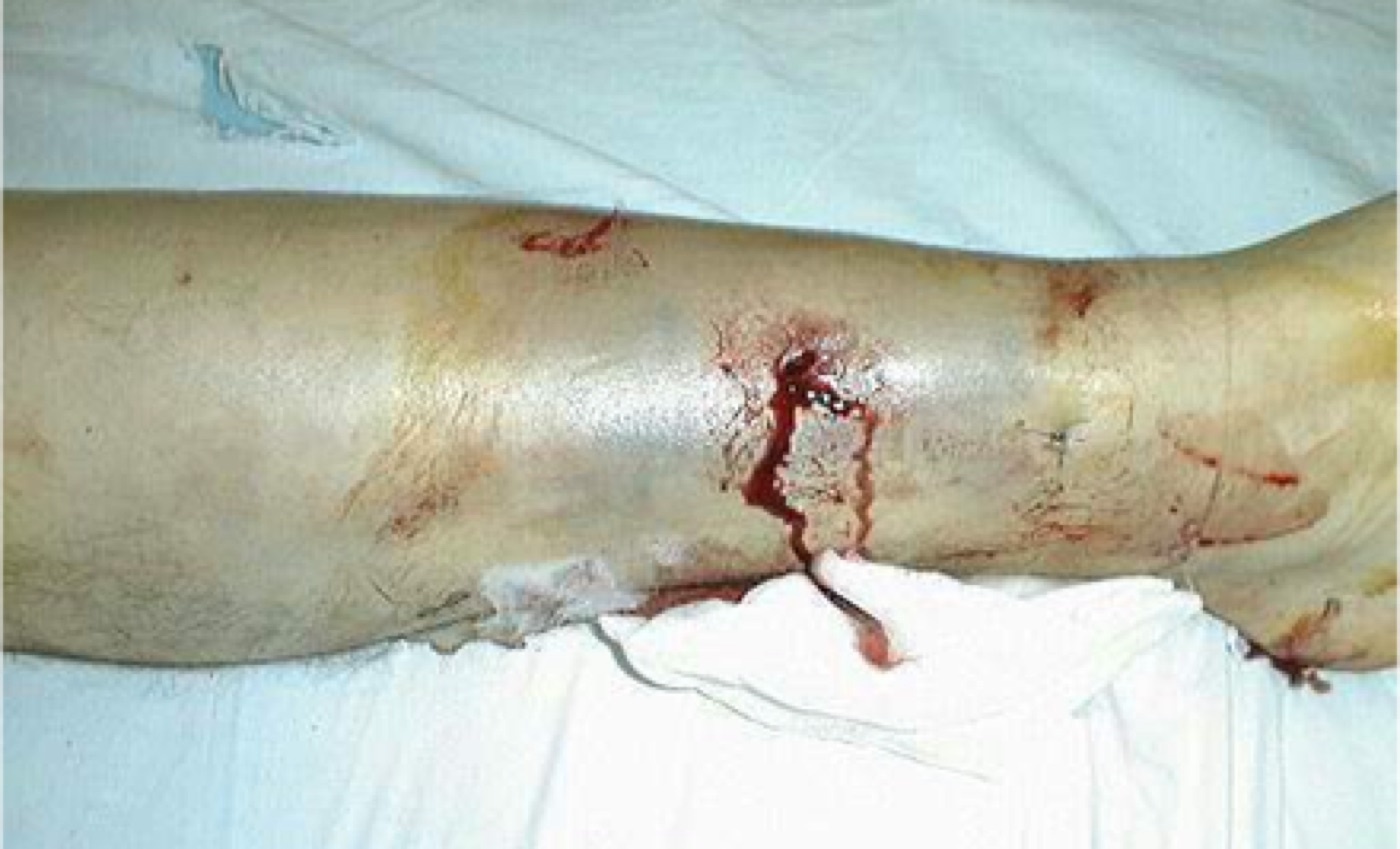 Figure 4. Gustilo-Anderson type I open tibial fracture: a small puncture wound with minimal soft-tissue injury. Image by Doncovska, CC BY-SA 3.0, via Wikimedia Commons.