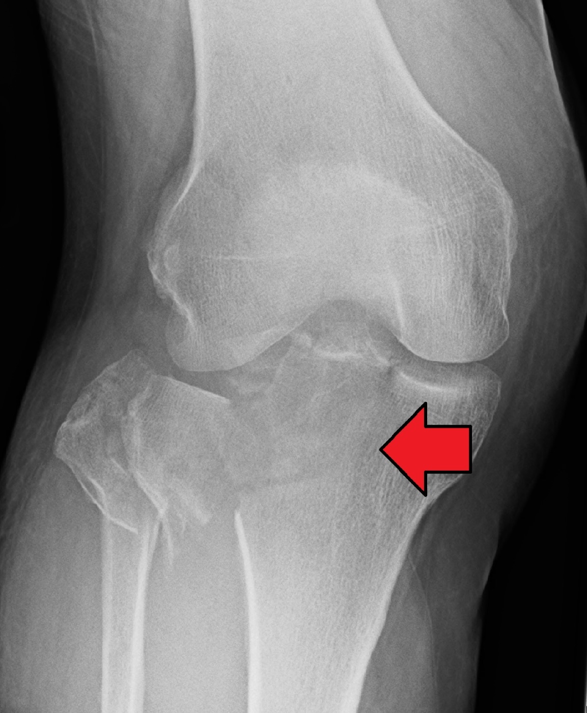 Figure 7. Severe, comminuted, displaced tibial plateau fracture (arrow) on a lateral radiograph, a high-energy injury pattern. Image by James Heilman, MD, CC BY-SA 4.0, via Wikimedia Commons.
