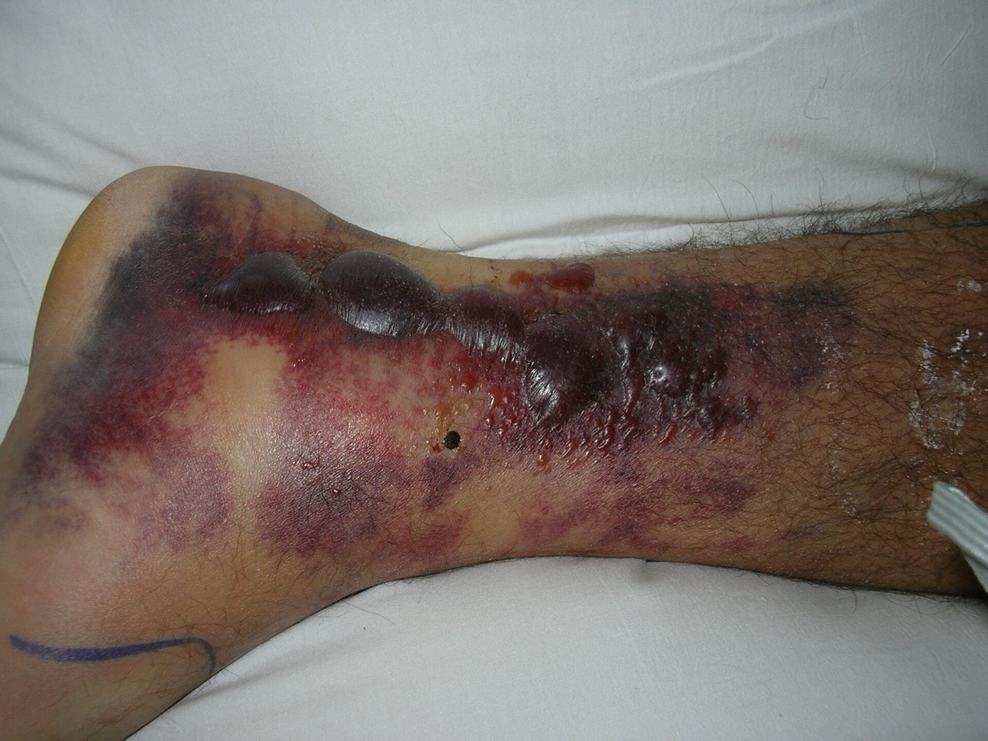 Figure 9. Haemorrhagic fracture blisters over a fractured lower limb, a compromised soft-tissue envelope that mandates staged management. Image by Cindy L. Budge, public domain, via Wikimedia Commons.
