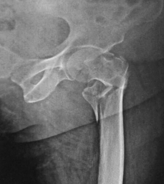 Figure 4. A comminuted (unstable) trochanteric fracture with a separate posteromedial fragment. Memon, Patel & Juva, CC BY 4.0, via Wikimedia Commons.