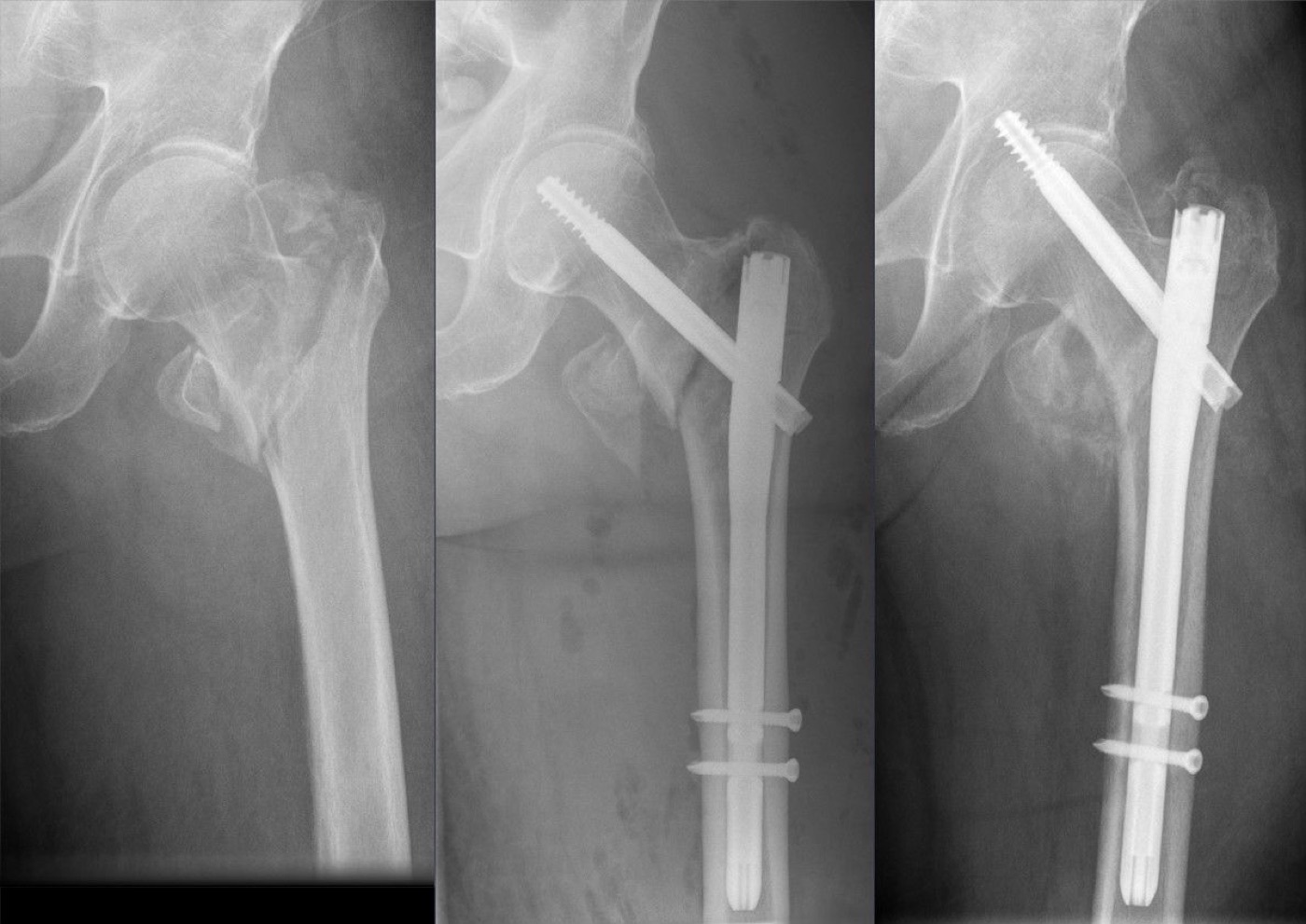 Figure 7. Screw cut-out after cephalomedullary nailing: the cephalic screw migrates through the femoral head toward the acetabulum. Hellerhoff, CC BY-SA 4.0, via Wikimedia Commons.