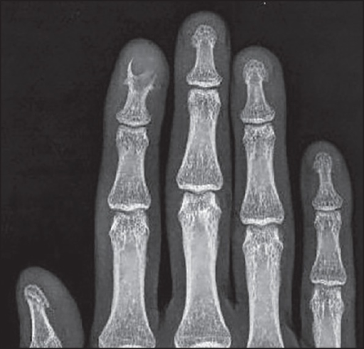 Radiograph. Intraosseous epidermoid (keratin) cyst - an expansile lytic lesion of a distal phalanx. Prasad et al., CC BY-NC-SA 3.0 (non-commercial), via PMC.
