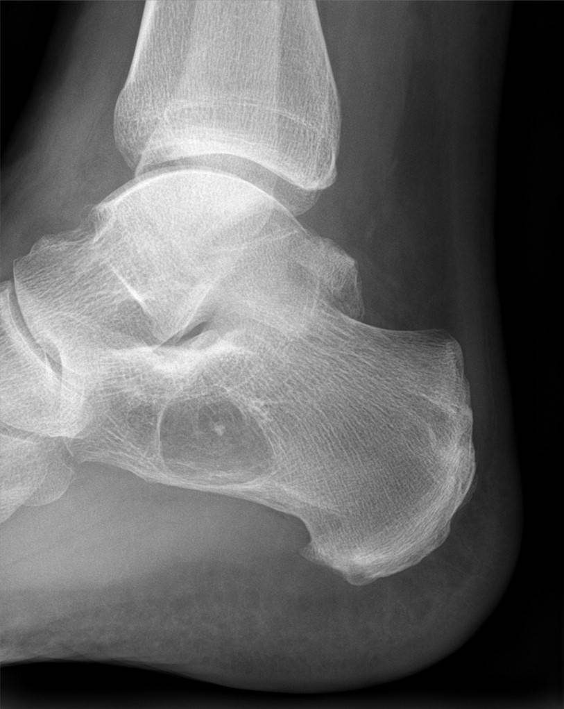 Radiograph. Intraosseous lipoma of the calcaneus - a lucent lesion with a central calcified nidus. Hellerhoff, CC BY-SA 4.0, via Wikimedia Commons.