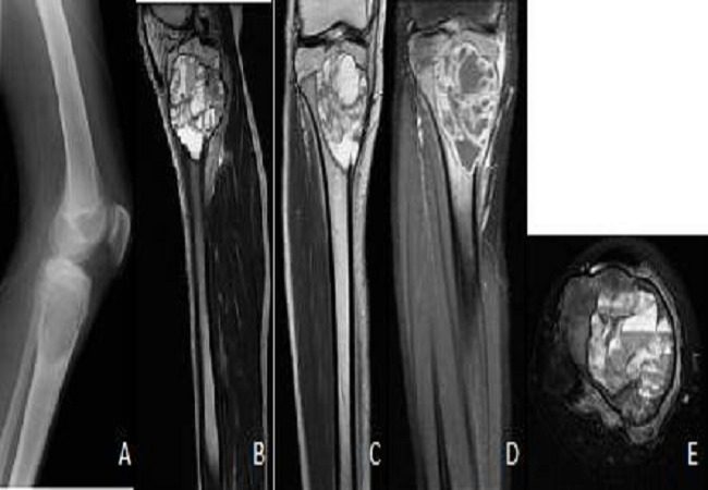 Radiograph / MRI. Aneurysmal bone cyst - an expansile, multiloculated lesion (plain film and MRI panels). Boubbou et al., CC BY 2.0, via Wikimedia Commons.