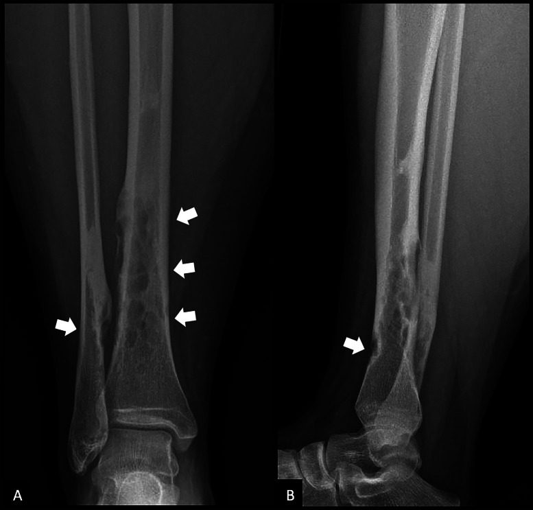 Radiograph. Osteofibrous dysplasia - intracortical lytic lesions with sclerotic margins in the distal tibia and fibula. Chabot & Janssens, CC BY 4.0, via PMC.