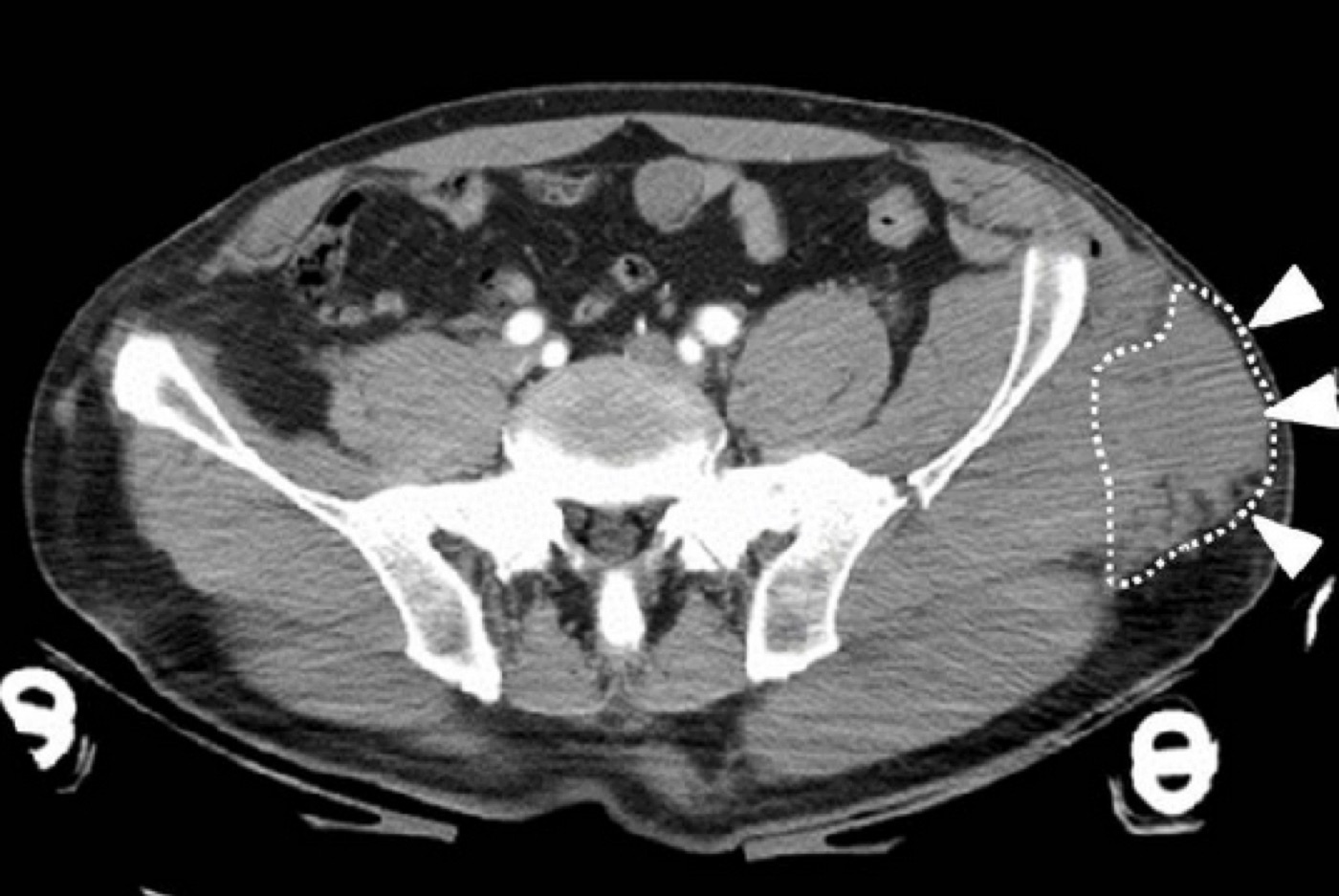 Figure 11. A Morel-Lavallée lesion (closed internal degloving) over the lateral hip on axial CT (arrowed). From Takahara et al. (2014), Case Reports in Orthopedics, doi:10.1155/2014/920317, via Wikimedia Commons, CC BY 3.0.