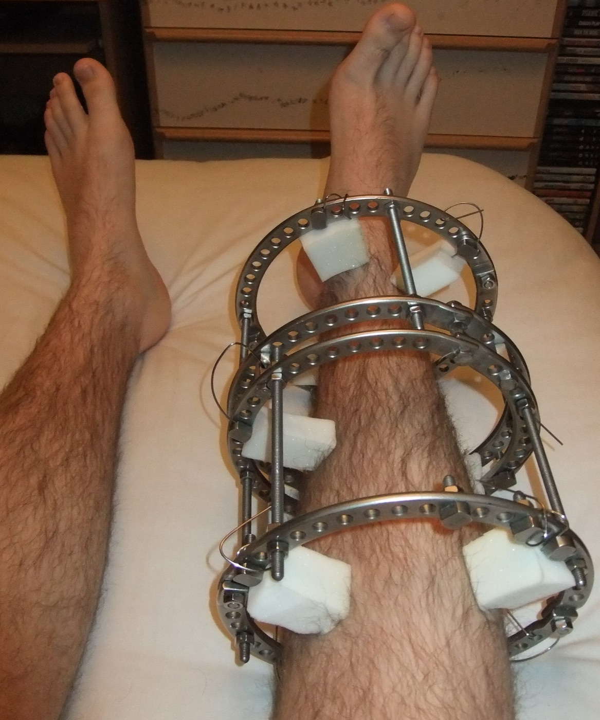 Figure 2. An Ilizarov circular external fixator on the leg, the damage-control workhorse for a contaminated high-grade open fracture. Source: Pagemaker787, via Wikimedia Commons, CC BY-SA 4.0.